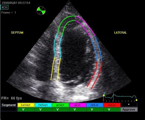 how to read echocardiogram|an echocardiogram bad test results.